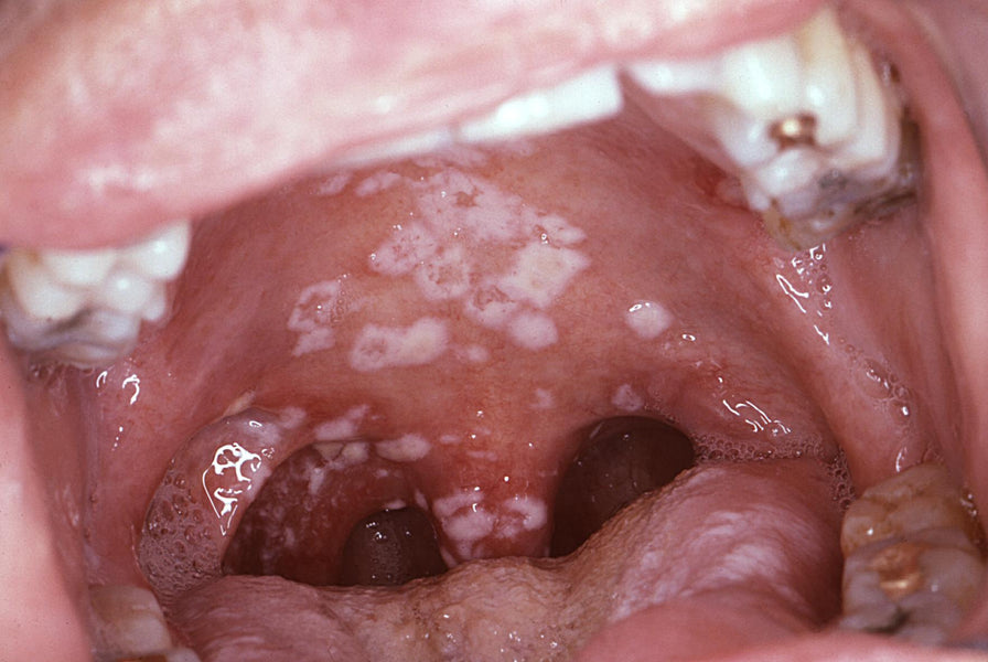 Xylitol and Oral Candidiasis