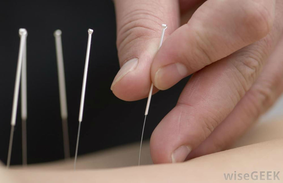 Relieving Side Effects of Cancer Treatments with Acupuncture