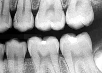 Dental X-rays – Are They Safe and Necessary?